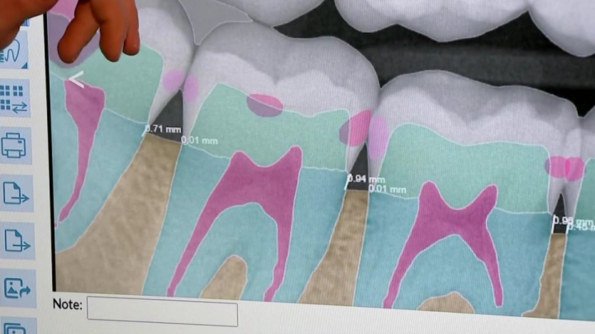 Marquette University dentist explores AI in predicting tooth loss [Video]