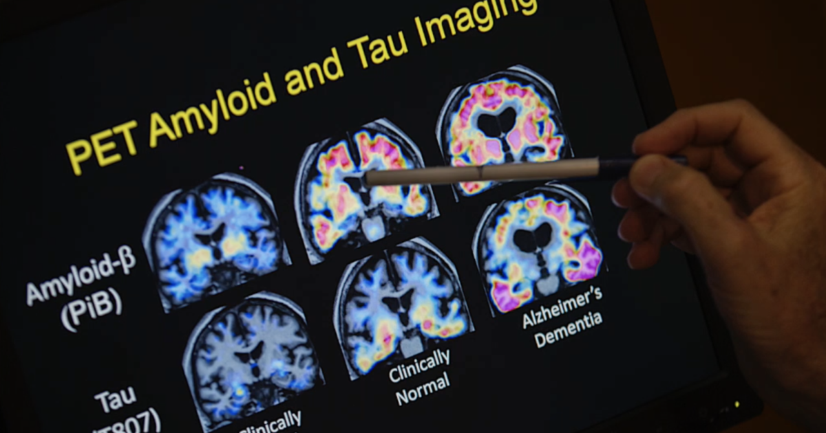 UMBC to study use of AI for neurodegenerative diseases [Video]