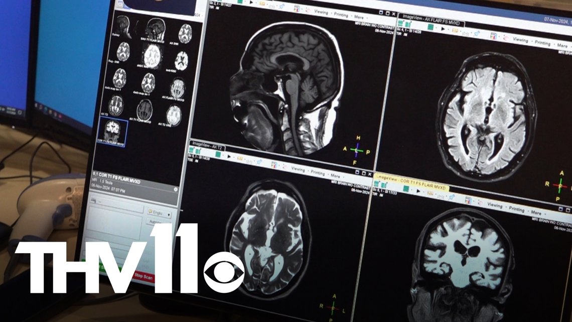 How AI is improving neuroradiology services in Arkansas [Video]