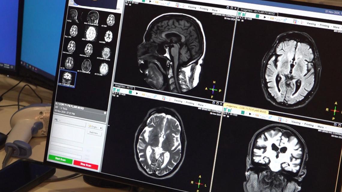 How AI is impacting neuroradiology in Arkansas [Video]