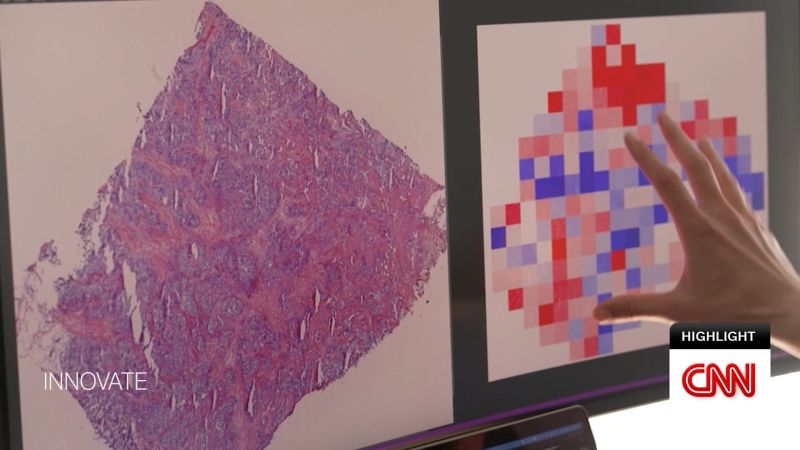 How an AI program could personalize breast and ovarian cancer care [Video]