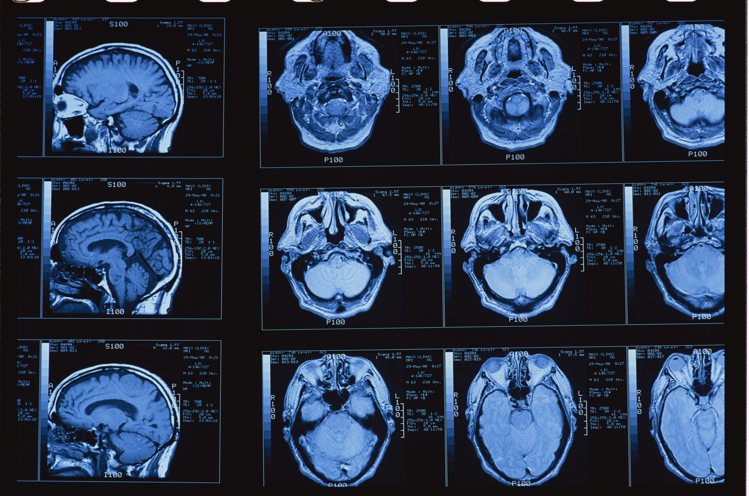 Doctors Gave AI Chatbots a Cognitive Test. Their Diagnosis? Early Dementia. [Video]